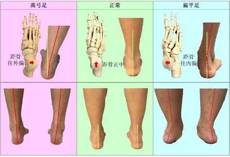 外八字腳|足內旋 (入字腳) 與足外旋 (八字腳) 